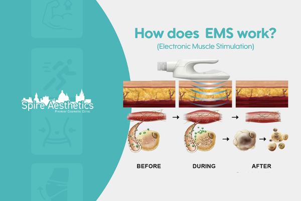 EMS treatment for post pregnancy weight loss treatment Calne