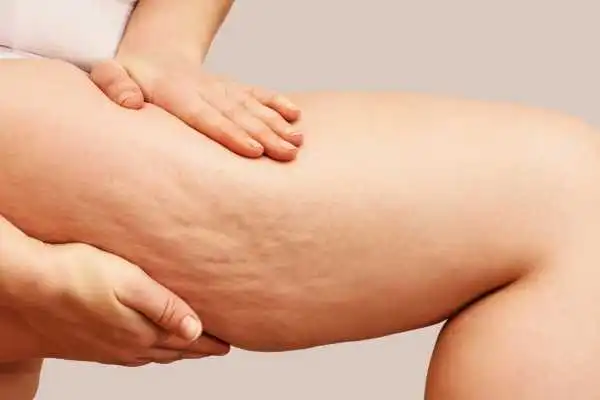Image of woman showing leg with cellulite Calne