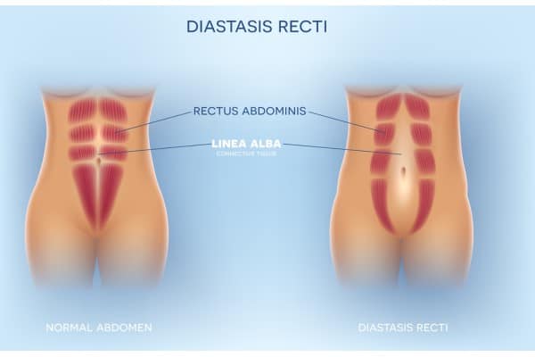 What Non-Surgical Options Are Available for Diastasis Recti Calne?