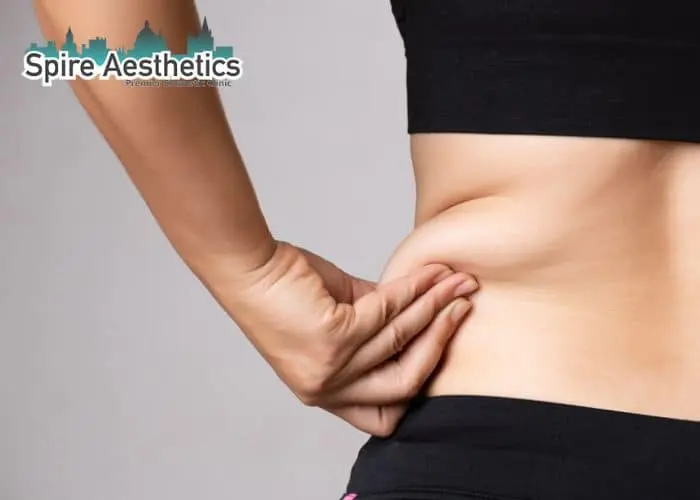 Image of woman pinching fat on their hips Calne. Fat Freezing treatment
