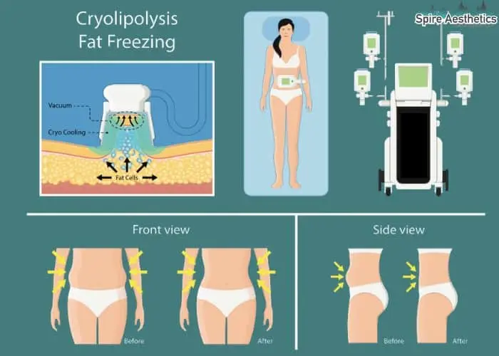 Fat freezing treatment Calne benefits for competitions to remove stubborn fat deposits.