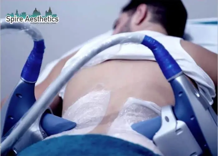 Man having fat freezing treatment done on love handles before a competitions Calne to create a sculpted look.