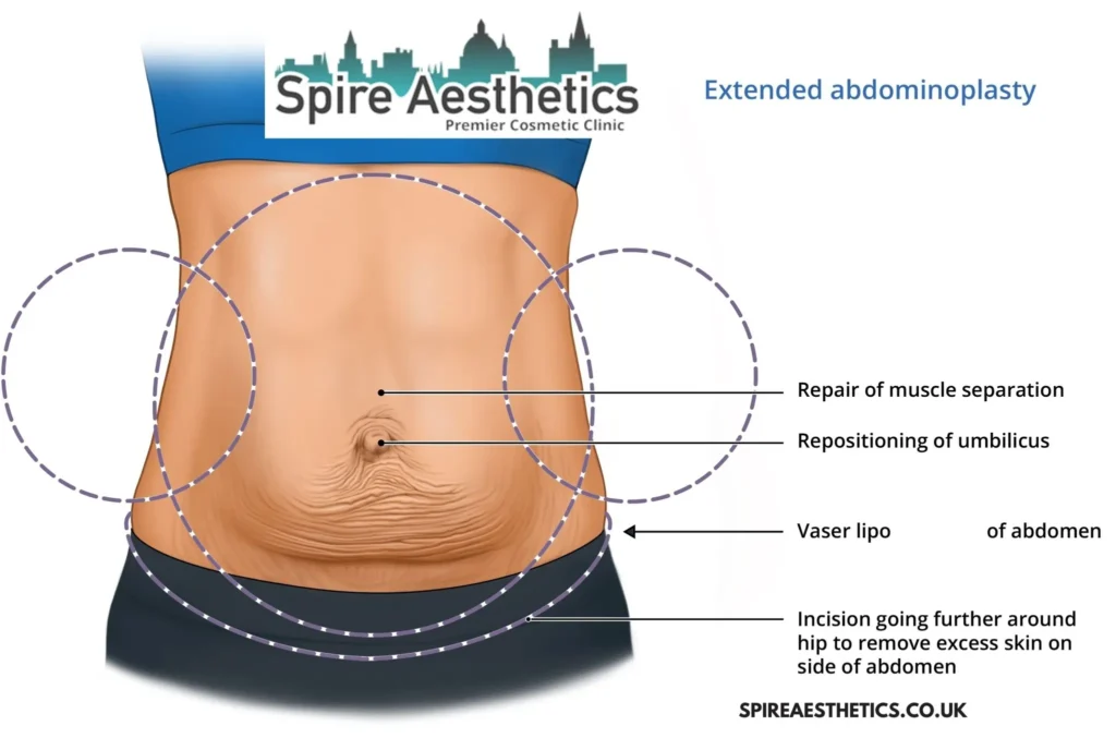 Understanding Loose Skin After Gastric Band Calne Surgery and HIFU Treatment