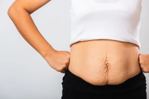 Image of a woman's stomach after weight loss with sagging skin following a gastric band Calne