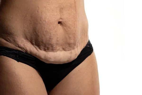 Image of womans stomach after weight loss injections Calne showing saggy skin