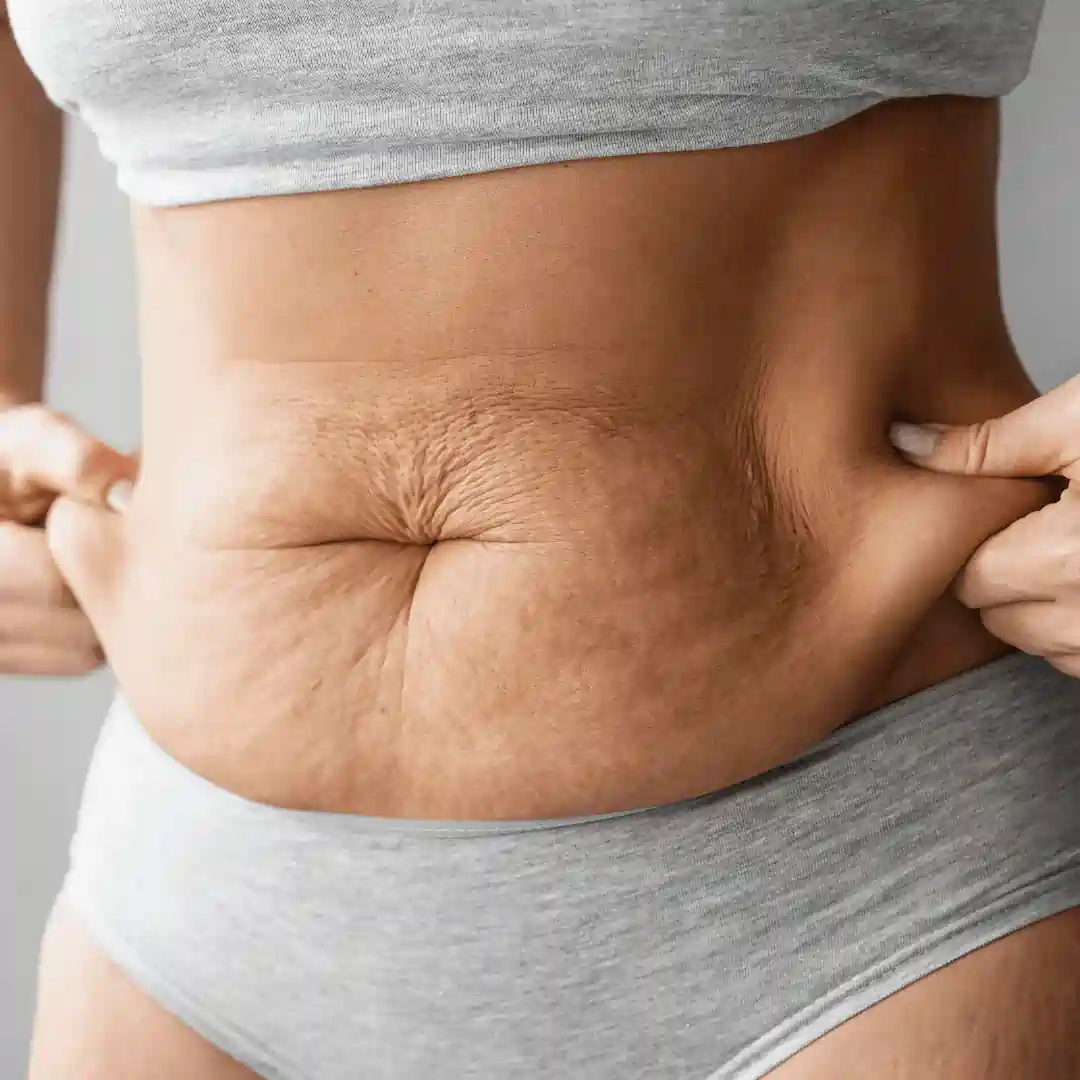 Is It Normal to Have Loose Skin After Pregnancy Calne?