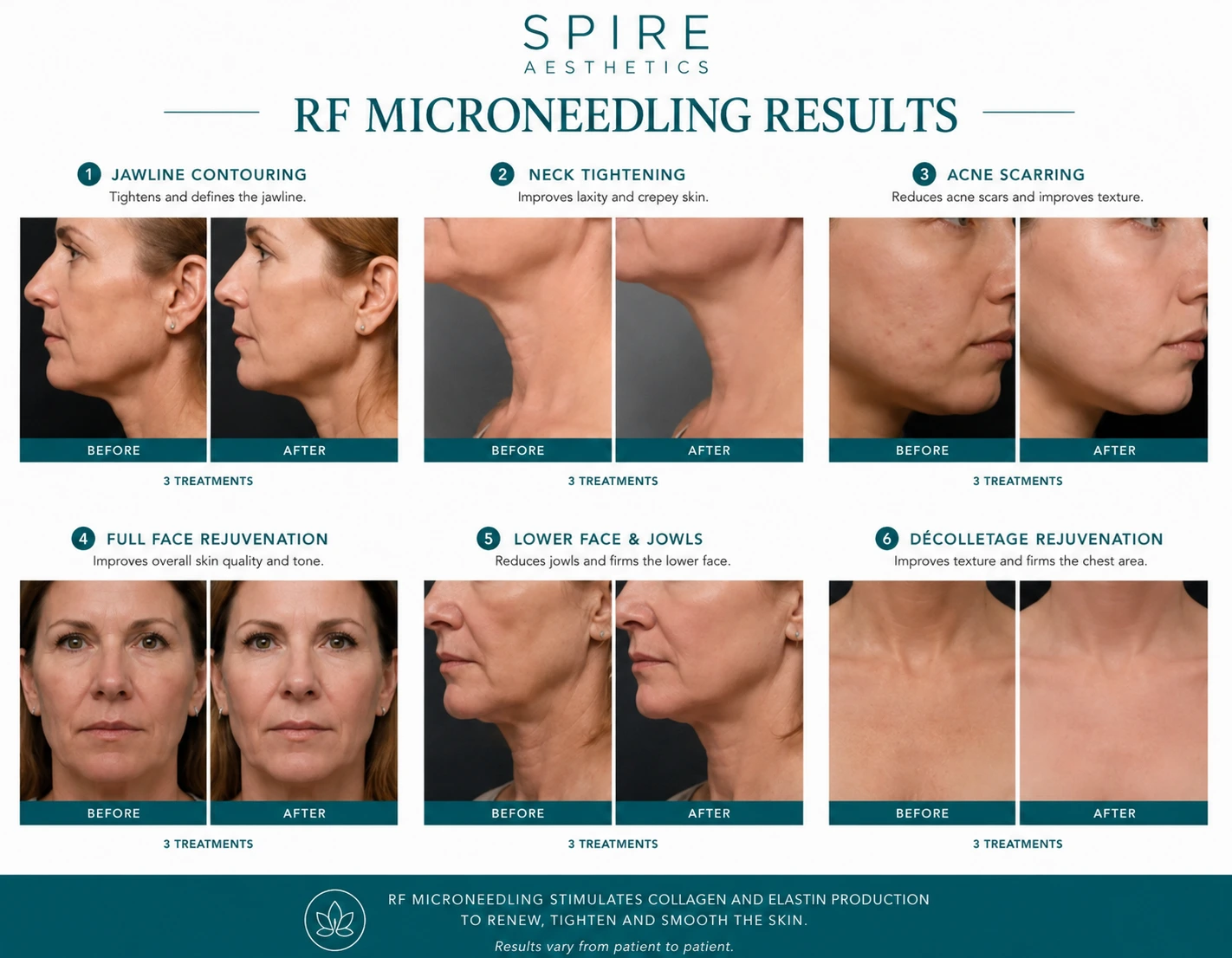 RF Microneedling Skin tightening Calne results