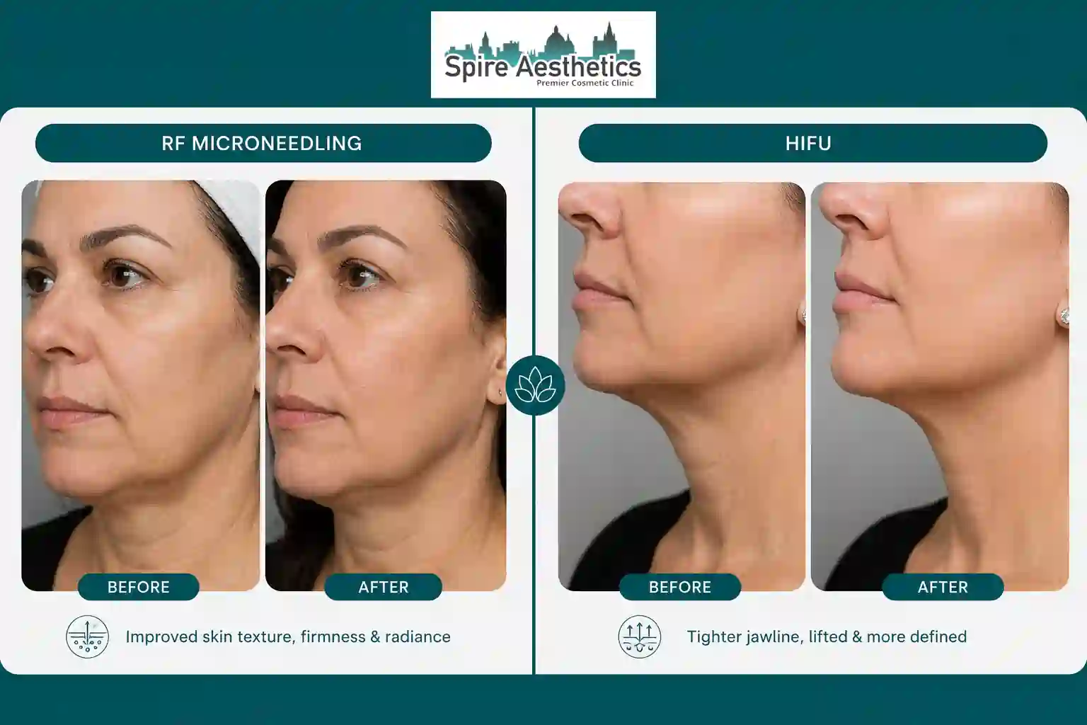 Can RF Microneedling and HIFU Be Combined Calne?