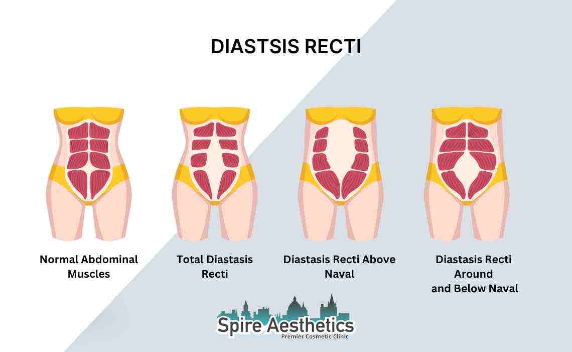 Is Non-Surgical Diastasis Recti Treatment Right for You? Common Concerns Answered Calne